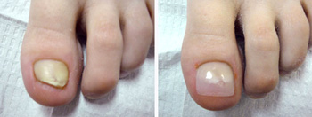 keryflex nail restoration.jpg