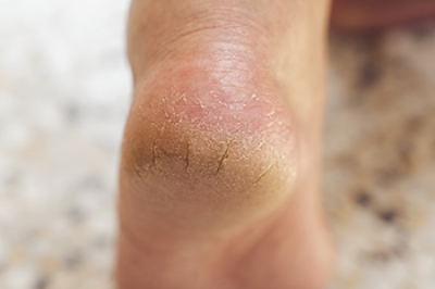 Key Highlights of Cracked Heels