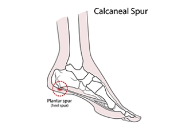 Facts About Heel Spur Surgery